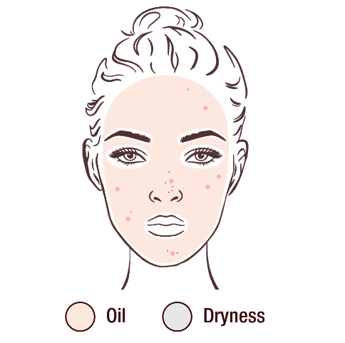 Illustration of a face showing areas prone to oiliness and dryness, marked with spots to indicate acne-prone zones.