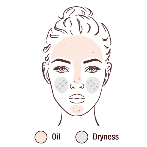 Illustration of a face showing areas prone to oiliness and dryness, marked with spots to indicate acne-prone zones. The forehead, nose, and chin areas are shaded to indicate oiliness, while the cheeks are marked to indicate dryness.